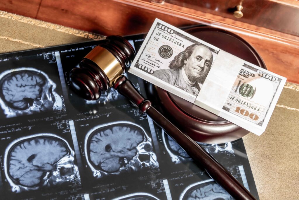 TBI compensation