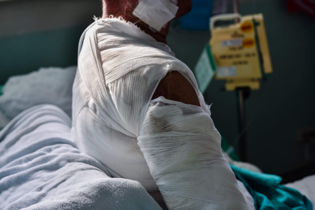 A patient sits in a hospital bed with extensive white medical bandages wrapping their shoulder and arm, illustrating severe injuries managed by San Antonio Burn Injury Lawyers.