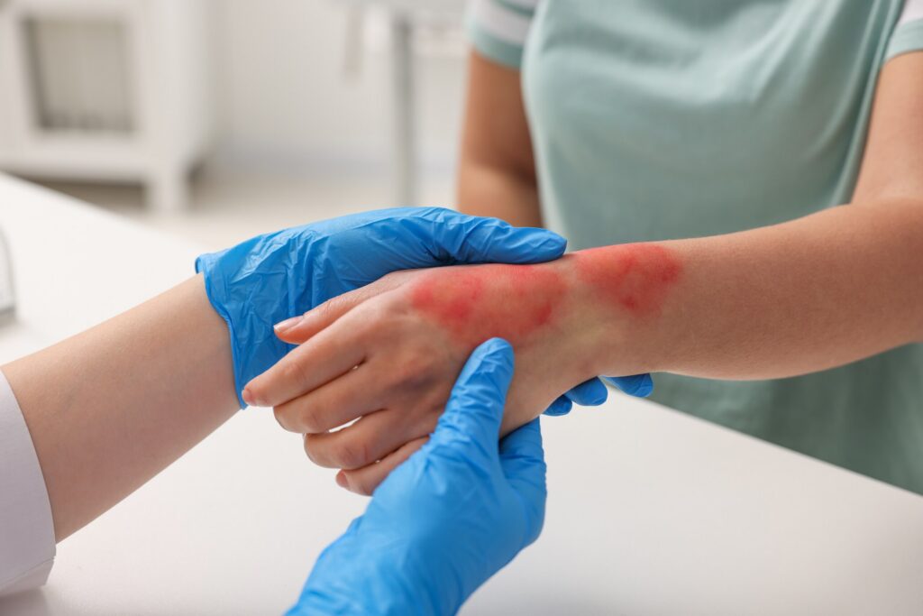 A medical professional in blue gloves examines a patient's red, burned wrist, relating to Texas Severe Burn Lawsuits & Compensation Rights.