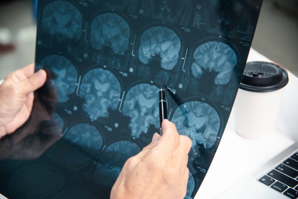 Doctor using a pen to point at brain scan MRI film.